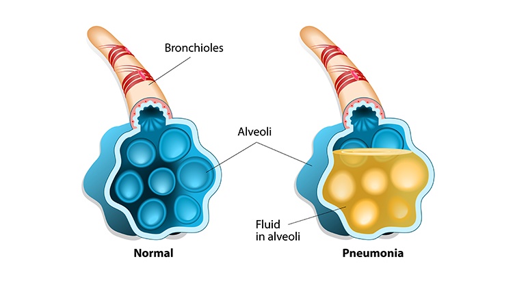 what_is_pneumonia