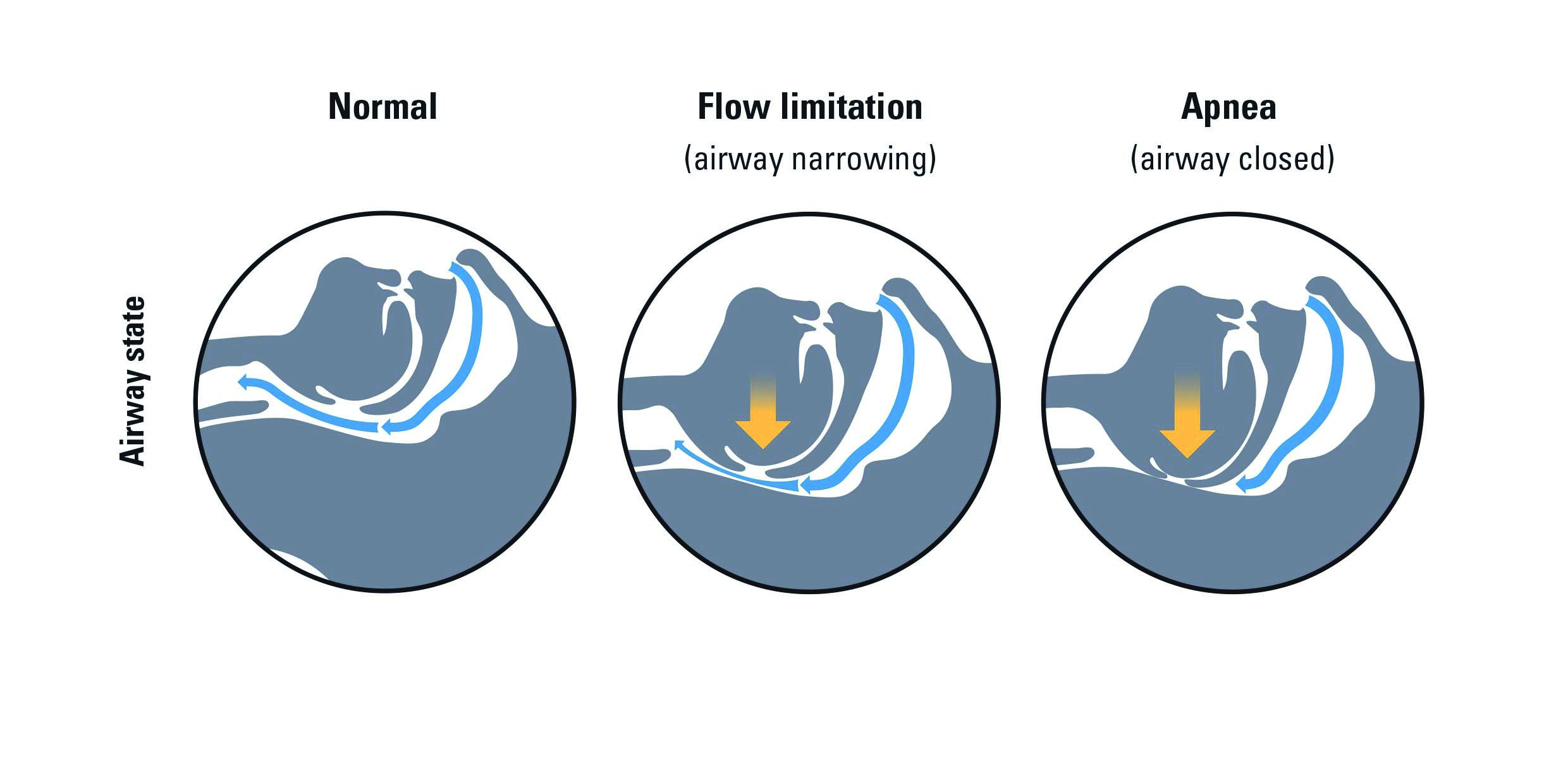 Obstructive Sleep Apnea Diagram