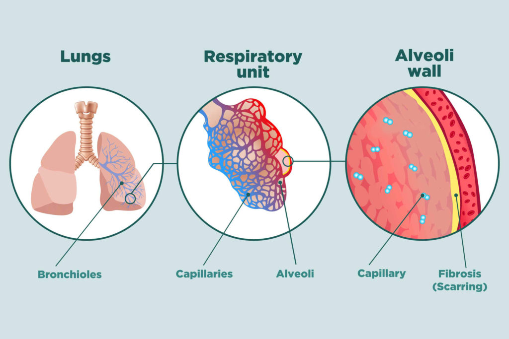 Facts About Pulmonary Fibrosis