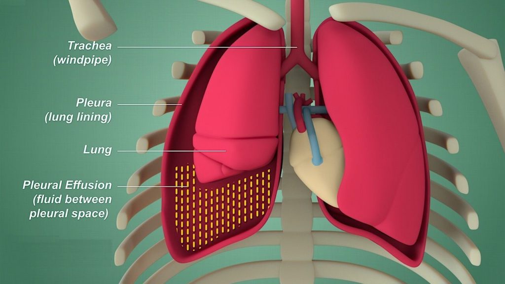 water in lungs